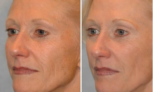 laser biorevitalization